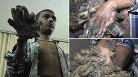 Bangladesh ‘Tree Man’ begs for hands to be CUT OFF after undergoing 25 surgeries