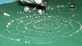 Dental surgeons remove 526 teeth from 7-year-old Indian boy’s mouth