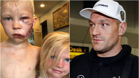 ‘If someone had to die it should be me’: Heroic 6yo boy bitten IN FACE by dog while shielding sister named honorary World Champ