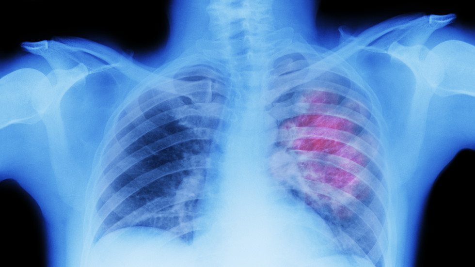 One in a hundred Covid-19 patients suffer punctured lung according to