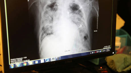 An X-ray of a COVID-19 patient's lungs. © Reuters / Lucy Nicholson