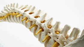 ‘We have a hint… it may be possible’: Controversial stem cell therapy repaired injured spinal cords in 13 patients