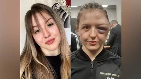 &lsquo;Before and after&rsquo;: German boxing starlet Cheyenne Hanson shows off horror head injuries after clash with Ukrainian fighter