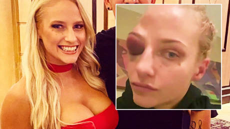 ‘No modeling for a few days’: Football-loving ‘Blonde Bomber’ says huge boxing bruise confused facial recognition software (VIDEO)