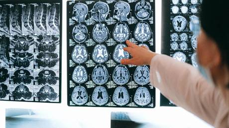 Researchers detect link between teenage brain thinning and onset of psychosis later in life