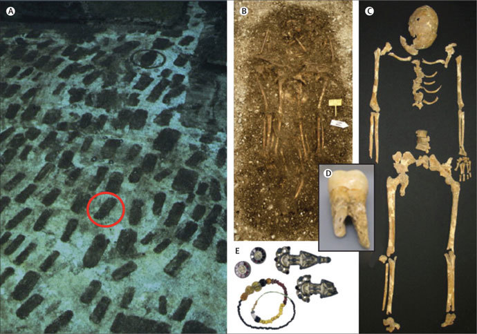 The cemetery in Bavaria, Germany (A). The skeleton of a victim of the Plague of Justinian (C). Objects (E) from the grave (B) that helped scientists to estimate the plague victimâs death as occurring between 525 AD and 550 AD. A tooth from which the genome of the plague was extracted (D). (Image from thelancet.com)
