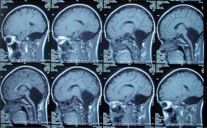 MRI scans of a female brain â the ninth case in medical history, when a relatively healthy person has no cerebellum (âA new case of complete primary cerebellar agenesis: clinical and imaging findings in a living patientâ, Feng Yu et al, Brain journal, August 2014)
