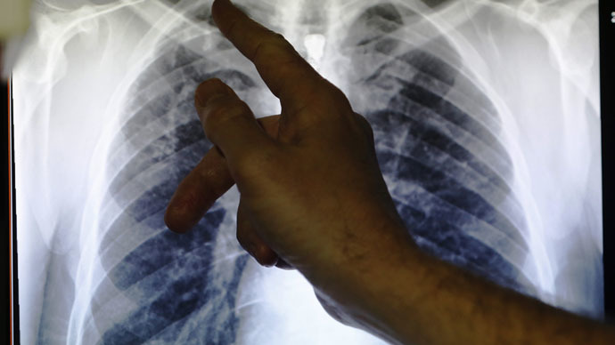 Kansas tuberculosis outbreak infects 28 high school students