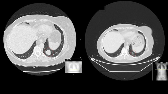Royal Marsden patient Vicky Brownâs CT scan before treatment (left) and 12 weeks after initial treatment. (image by Royal Marsden)