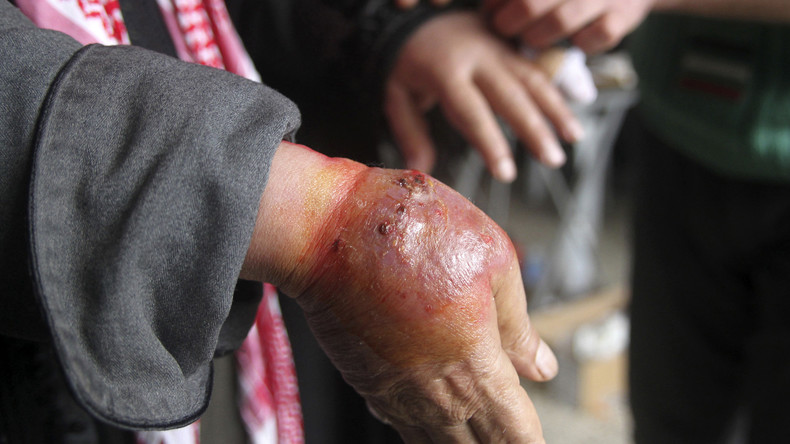Syrie : alerte à la maladie dévoreuse de chair (IMAGES PERTURBANTES)