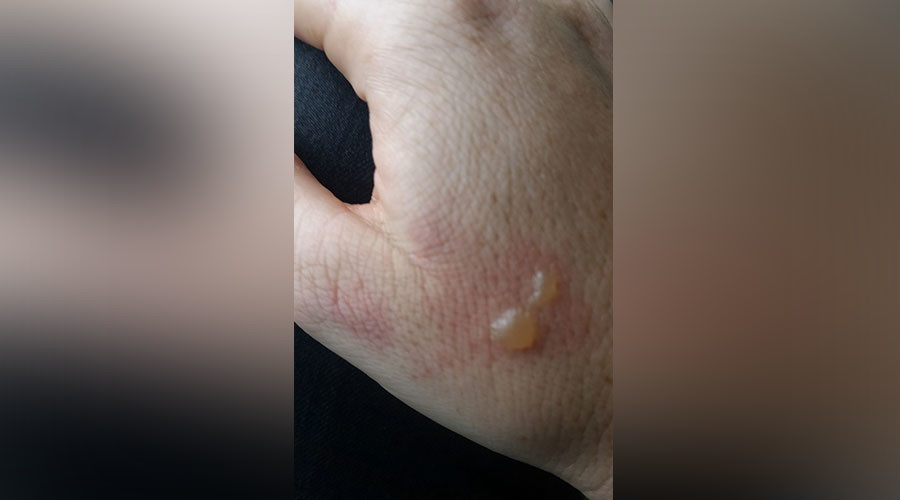Des écouteurs explosent en plein vol et brûlent une femme au visage (PHOTOS)