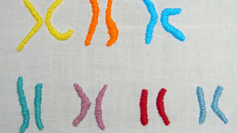 Ученые смогут блокировать лишнюю хромосому у людей с синдромом Дауна